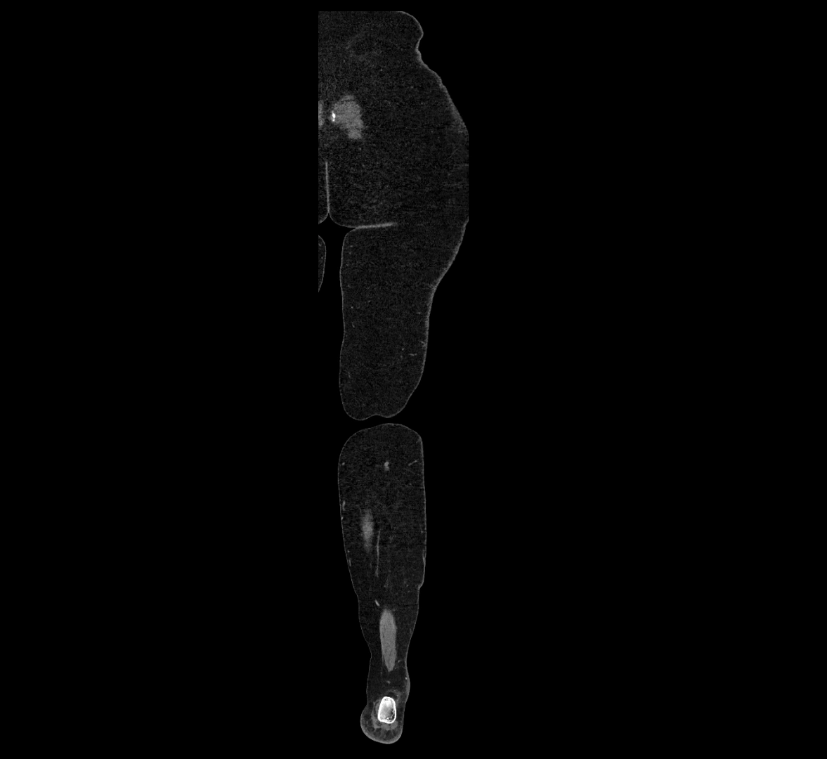 CTA lower limb coronal cross sectional anatomy labelled image _85 (2).webp